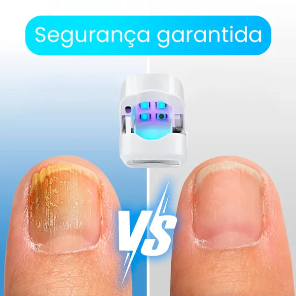 ¡Deshazte de los hongos y uñas débiles en solo 6 ciclos! Tratamiento láser rápido y seguro con CuraLáser.