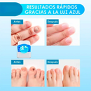¡Deshazte de los hongos y uñas débiles en solo 6 ciclos! Tratamiento láser rápido y seguro con CuraLáser.